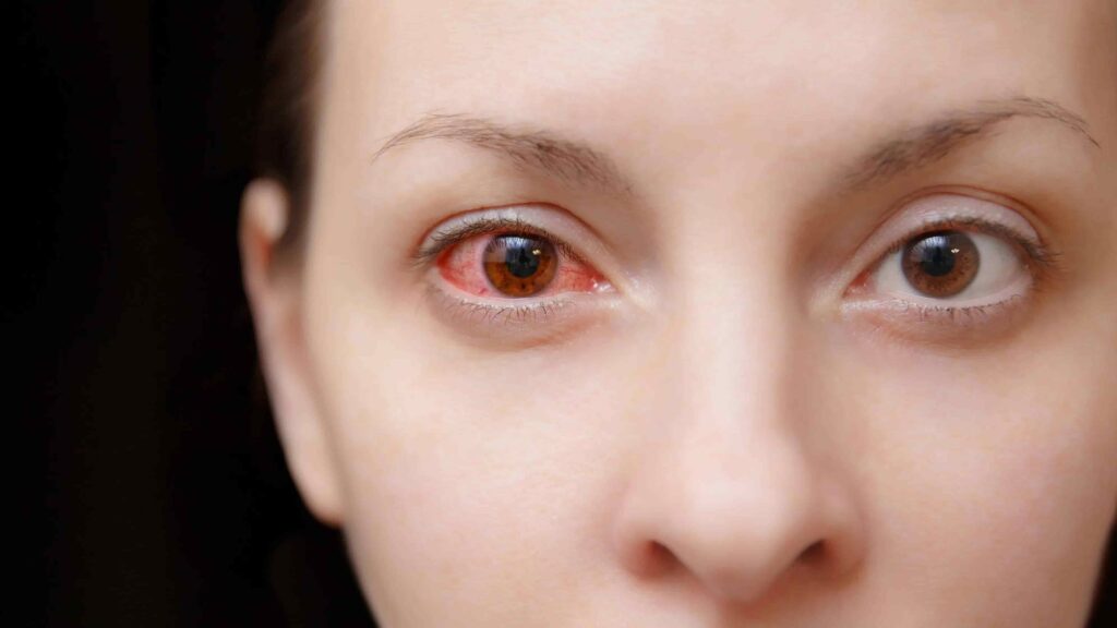 Pink Eye treatment in Dallas